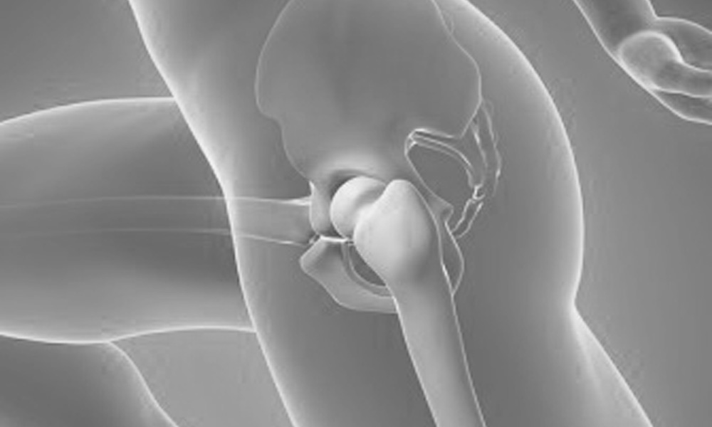 Arthritis