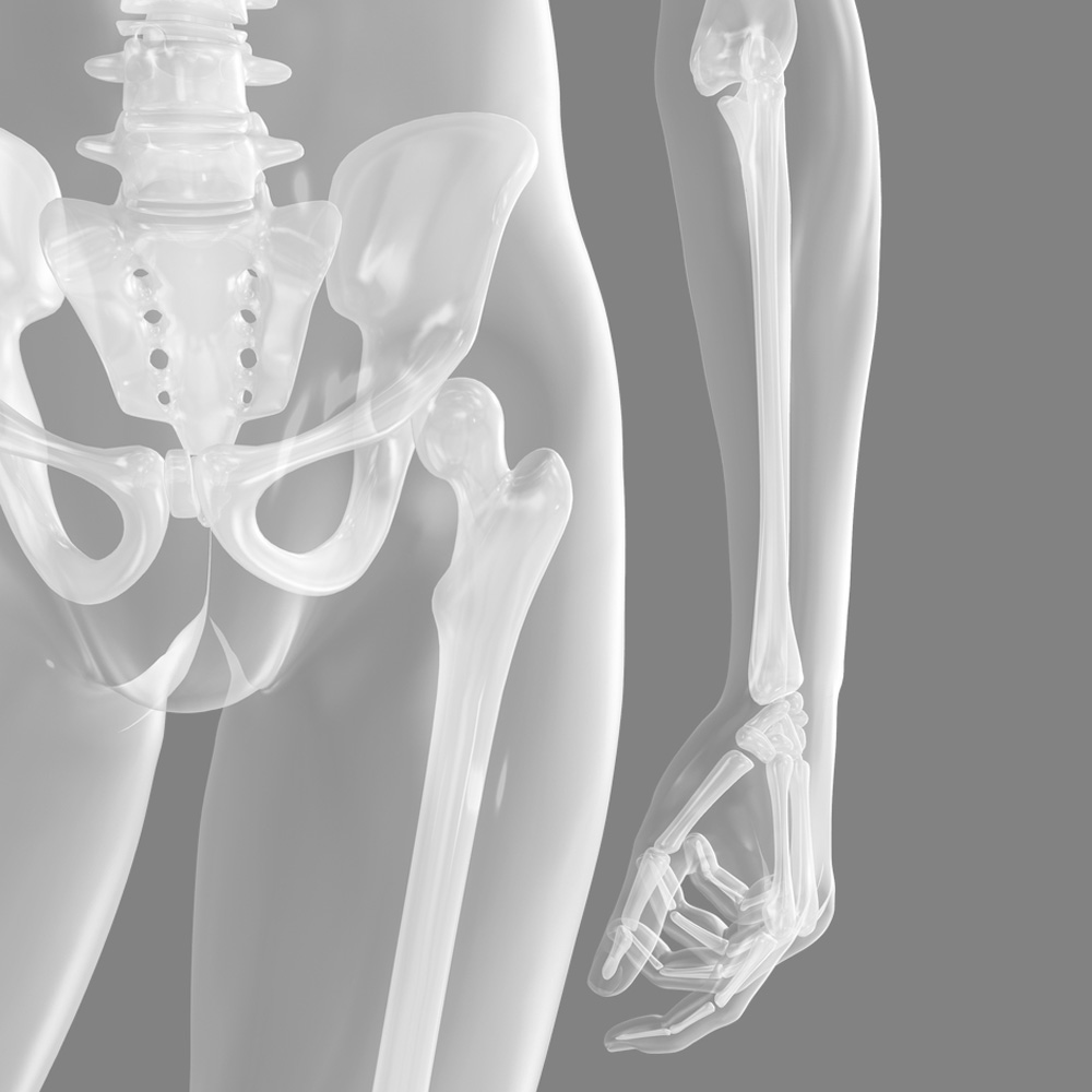 Hip Replacement