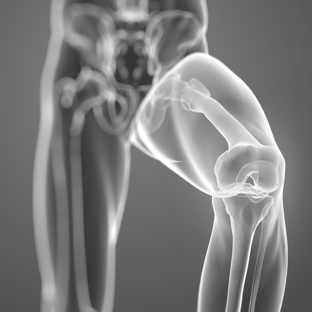 Knee Replacement